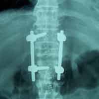 Best Spine Surgeon in Rajasthan |Orthopedic Oncology Doctor 