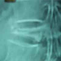 Joint Replacement in Ahmedabad|Best spine surgeon in ahmedabad