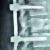 Joint Replacement in Ahmedabad|Trauma Surgeon in Ahmedabad