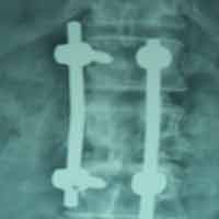 Orthopedic Oncology Doctor In Ahmedabad|Limb Reconstruction Doctor