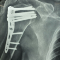 Spine Treatment In Vastrapur|Best spine surgeon