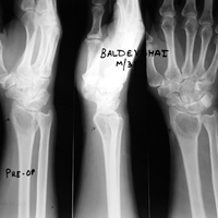 Limb Reconstruction Doctor in Ahmedabad