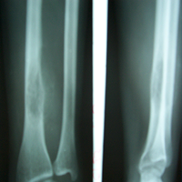 Spine Treatment In Jaipur|Best Trauma Surgeon