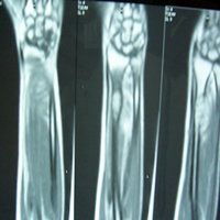 Trauma Surgeon in Ahmedabad|Joint Replacement 