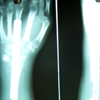 Limb Reconstruction Doctor|Sports Injuries Doctor