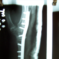 Spine Best doctor in satellite |Best Trauma Surgeon