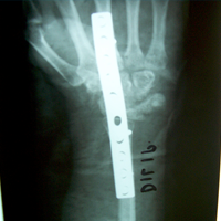 Limb Reconstruction Doctor|Best spine surgeon