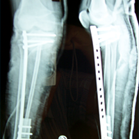 Spine Treatment In Jaipur|Sports Injuries Doctor