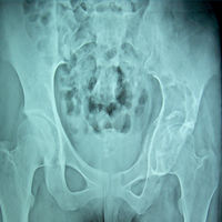 Orthopedic Oncology Doctor|Spine Surgeon Best In Rajasthan