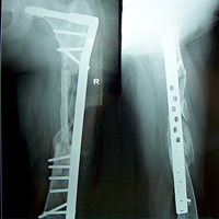 Joint Replacement