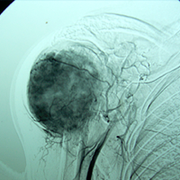 Orthopedic Oncology Doctor In Ahmedabad