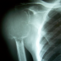 Best spine surgeon in ahmedabad