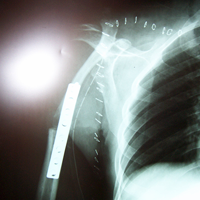 Orthopedic Oncology Doctor In Ahmedabad