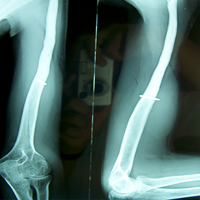 Orthopedic Oncology Doctor In Ahmedabad