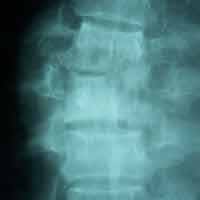 Joint Replacement in Ahmedabad|Best Trauma Surgeon in Ahmedbad