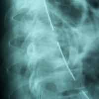 Best Spine Surgeon in Rajasthan | Orthopedic Oncology Doctor