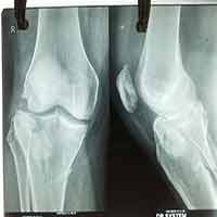 Limb Reconstruction Doctor|Sports Injuries Doctor